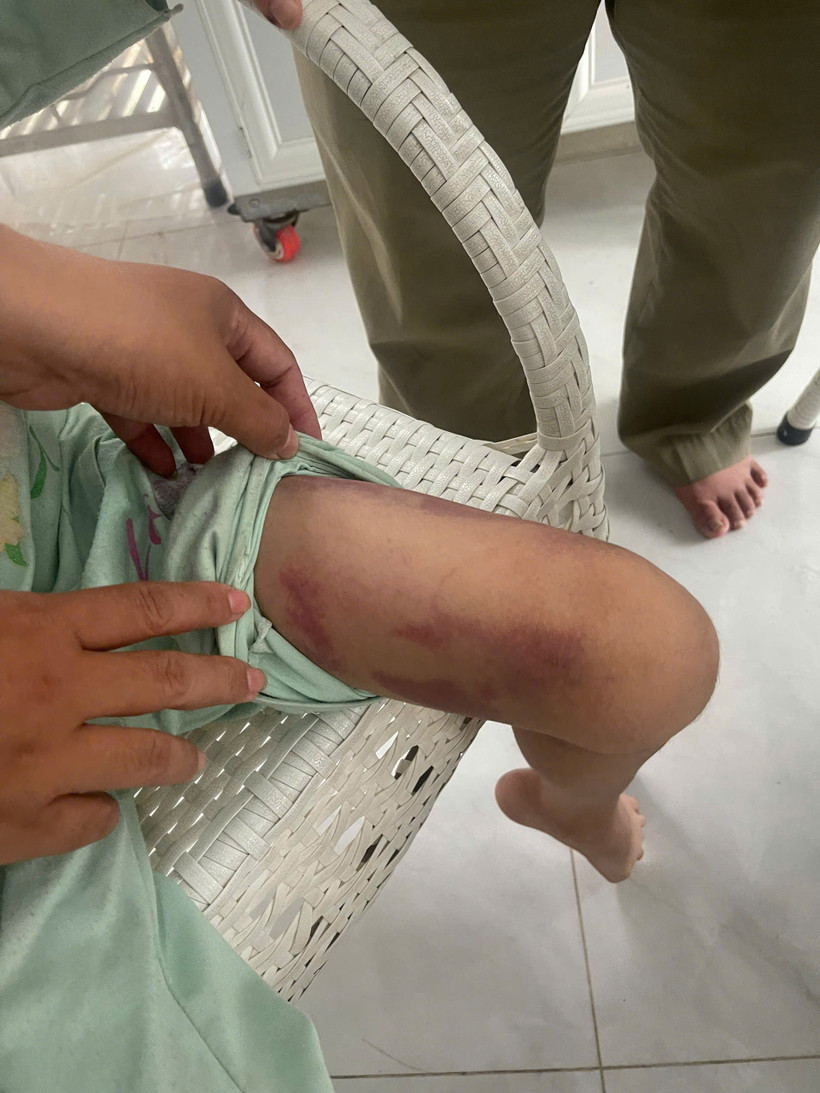 Thương tích trên người bé M.T. (Ảnh: PV/Vietnam+)