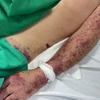 Bệnh nhân bị xuất huyết do vi khuẩn liên cầu lợn gây ra. (Ảnh: Bệnh viện Bệnh Nhiệt đới Trung ương)