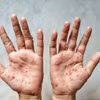 Một bệnh nhân bị mắc bệnh đậu mùa khỉ. (Ảnh: Shutterstock/TTXVN)