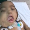 Bệnh nhi có khối u quái vùng má bên phải từ lúc 4 tháng tuổi và lớn lên từng ngày. (Ảnh: Mai Trang/TTXVN)