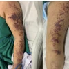 Hình ảnh cơ thể bệnh nhân khi bị mắc liên cầu lợn. (Ảnh minh họa: PV/Vietnam+)