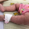 Một bệnh nhi mắc sởi. (Ảnh minh họa. Nguồn: TTXVN)