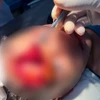 Bé trai 7 tuổi tại thị xã Đông Hòa bị chó nhà cắn, gây vết thương lớn ở vùng mặt hồi đầu tháng 8/2024. (Ảnh: TTXVN phát)