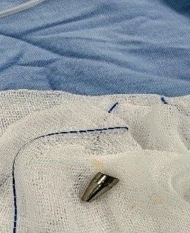 Dị vật là đầu ngòi bút, bề dày thành khoảng 1,8mm, chiều dài khoảng 18mm. (Nguồn: Bệnh viện Phụ sản-Nhi Đà Nẵng)