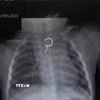 Hình ảnh X-quang phát hiện dị vật cản quang tại thực quản. (Ảnh: TTXVN phát)