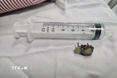 Dị vật là 2 chiếc răng giả được nội soi lấy ra khỏi phế quản bệnh nhân. (Ảnh: TTXVN phát)