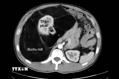 Hình ảnh phim chụp CT cho thấy khối bướu mỡ choán gần hết ổ bụng của người bệnh. (Ảnh: TTXVN phát)