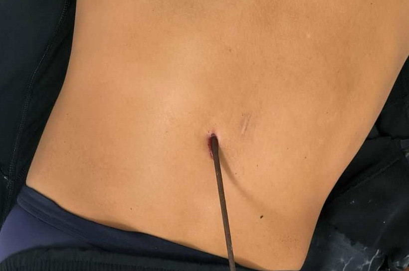 Anh N.T.A. bị mũi tên súng bắn cá đâm xuyên phổi. (Ảnh: TTXVN phát)