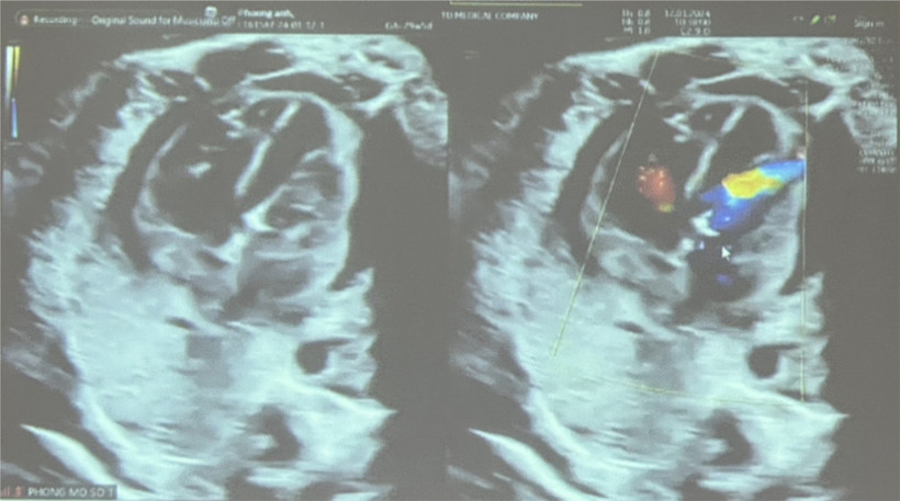 Siêu âm sau can thiệp tim mạch bào thai. (Ảnh: Đinh Hằng/TTXVN)