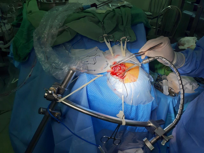 Các bác sỹ can thiệp kẹp cổ túi phình, cứu sống bệnh nhân. (Ảnh: TTXVN)