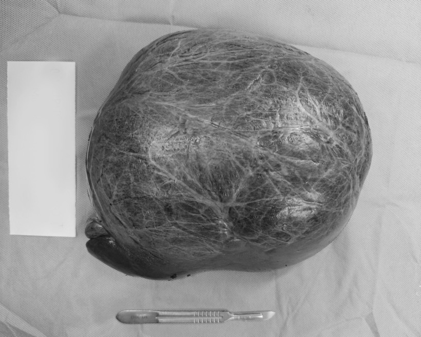 Khối u gan khổng lồ nặng 3kg được các bác sỹ Bệnh viện Quân y 175 phẫu thuật cắt bỏ thành công. (Ảnh: TTXVN phát)