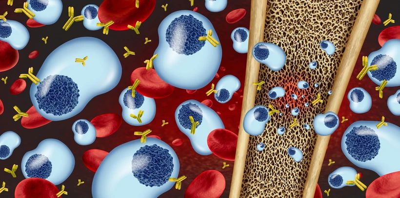 Bệnh đa u tủy xương gây ra do rối loạn tế bào plasma (màu xanh), hình thành các ổ tiêu xương. (Ảnh minh hoạ: Shutterstock)