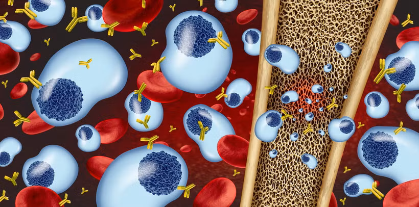 Bệnh đa u tủy xương gây ra do rối loạn tế bào plasma (màu xanh), hình thành các ổ tiêu xương. (Ảnh minh hoạ: Shutterstock)