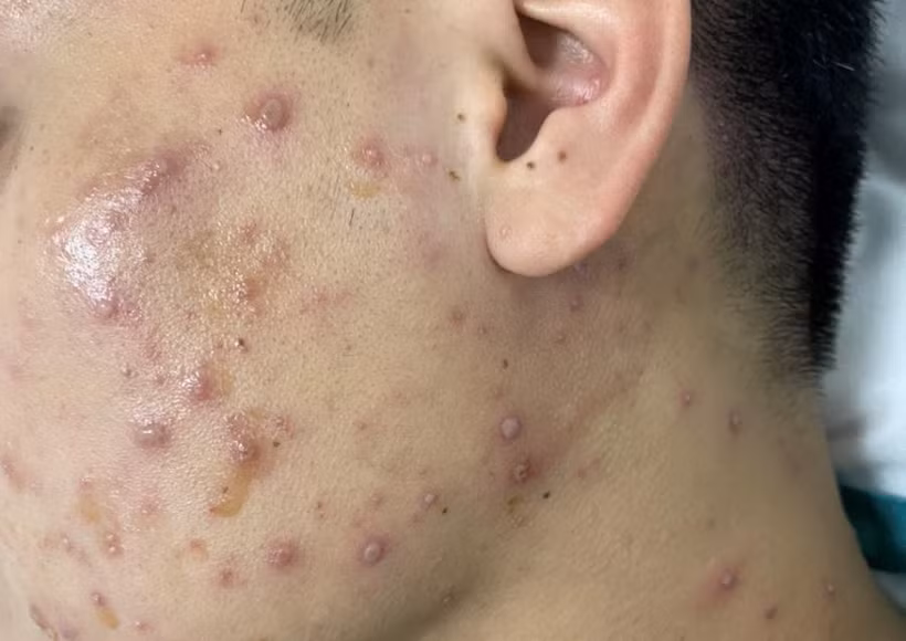 Nốt phỏng trên da người bị bệnh thủy đậu. (Nguồn: Vietnam+)
