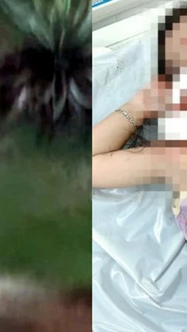 TP Hồ Chí Minh: Bé gái 4 tuổi bị chó tấn công, thương tích nghiêm trọng vùng mặt