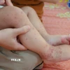 Các nốt bọng trên chân trẻ mắc tay chân miệng. (Ảnh: TTXVN phát)