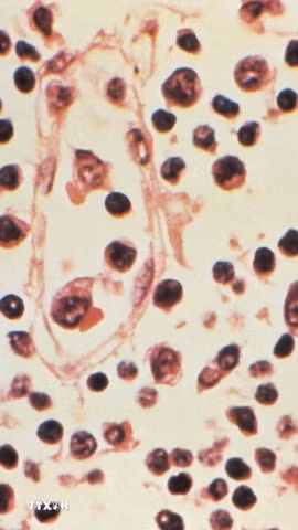 Mẫu bệnh phẩm của một bệnh nhân nhiễm virus Hanta. (Ảnh: Reuters/TTXVN)