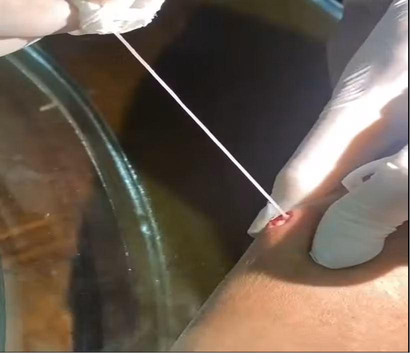 Đoạn giun rồng kéo ra từ cánh tay anh T. dài khoảng 10-15cm do người nhà tự nặn. (Ảnh: PV/Vietnam+) 