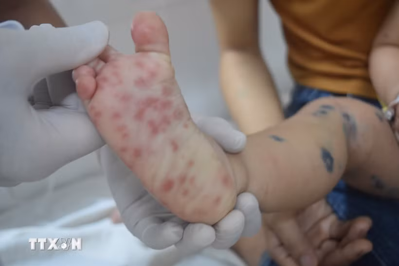 Các nốt phát ban của bệnh nhi bị tay chân miệng. (Ảnh minh họa: TTXVN)