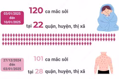 Hà Nội: Dự báo dịch sởi còn tiếp tục tăng trong 3 tháng đầu năm 