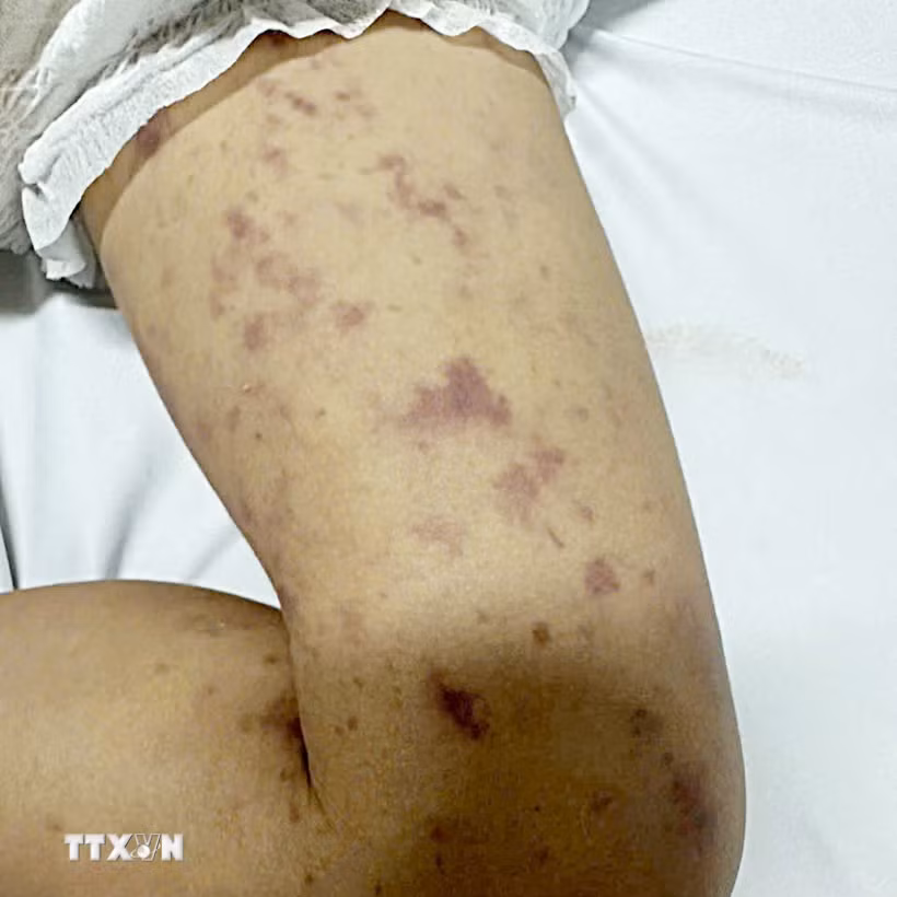 Bệnh nhi mắc viêm não mô cầu xuất hiện những xuất huyết dưới da trên da khắp cơ thể. (Ảnh: TTXVN phát)