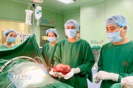 Các bác sỹ phẫu thuật lấy trọn khối u gan lớn ra khỏi cơ thể bệnh nhân. (Ảnh: TTXVN phát)
