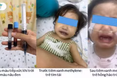 Bé gái tím tái, nguy kịch sau khoảng 1 giờ ăn ghẹ và canh cải bó xôi nấu với nước giếng. (Nguồn: Bệnh viện Nhi đồng Thành phố)