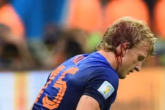 Dirk Kuyt chảy máu ròng ròng vẫn chiến với Brazil tới cuối trận