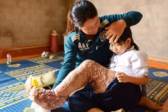 Bé Nguyễn Thị Loan khi phải chung sống với cái 'chân voi' sần sùi, đau đớn. (Ảnh: Báo Lâm Đồng)