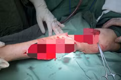 Cánh tay phải của Bà H.T.N, ngụ xã Hàm Thắng, huyện Hàm Tân, tỉnh Bình Thuận bị chính chó nhà nuôi tấn công khi đang hái rau tại vườn. (Ảnh: TTXVN phát)