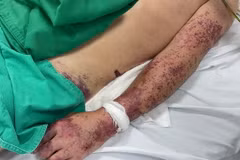 Bệnh nhân bị xuất huyết do vi khuẩn liên cầu lợn gây ra. (Ảnh: Bệnh viện Bệnh Nhiệt đới Trung ương)