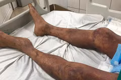 Một trường hợp toàn thân tím đen vì mắc liên cầu lợn. (Ảnh: PV/Vietnam+)