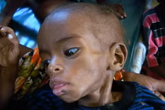 Trẻ em Somalia bị suy dinh dưỡng nặng điều trị tại bệnh viện ở Mogadishu ngày 2/8. (Ảnh: AFP/TTXVN)