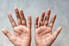 Các ban đỏ nổi trên tay một bệnh nhân mắc đậu mùa khỉ. (Ảnh: Shutterstock/TTXVN) 