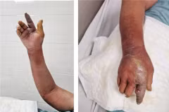 Hình ảnh tổn thương viêm mô bào của bệnh nhân. (Ảnh do bệnh viện cung cấp)