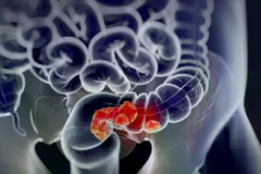 (Nguồn: Cancer network)