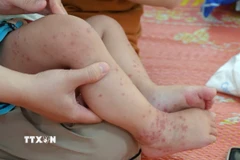 Các nốt bọng trên chân trẻ mắc tay chân miệng. (Ảnh: TTXVN phát)
