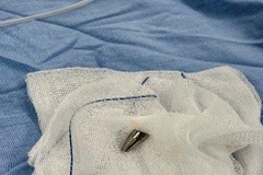 Dị vật là đầu ngòi bút, bề dày thành khoảng 1,8mm, chiều dài khoảng 18mm. (Nguồn: Bệnh viện Phụ sản-Nhi Đà Nẵng)