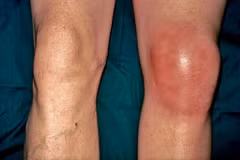 Áp dụng phương pháp dân gian chữa gout, người đàn ông có nguy cơ tàn phế