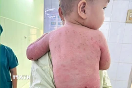 Thời điểm xuất viện, toàn bộ da bị bỏng nặng trước đây đã phục hồi hoàn toàn. (Ảnh: TTXVN phát)