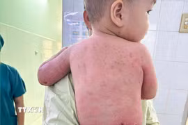 Thời điểm xuất viện, toàn bộ da bị bỏng nặng trước đây đã phục hồi hoàn toàn. (Ảnh: TTXVN phát)