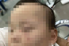 Bắc Ninh: Điều tra vụ việc cháu bé bị bầm tím 2 má nghi do bị bạo hành