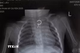 Hình ảnh X-quang phát hiện dị vật cản quang tại thực quản. (Ảnh: TTXVN phát)