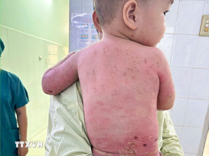 Thời điểm xuất viện, toàn bộ da bị bỏng nặng trước đây đã phục hồi hoàn toàn. (Ảnh: TTXVN phát)