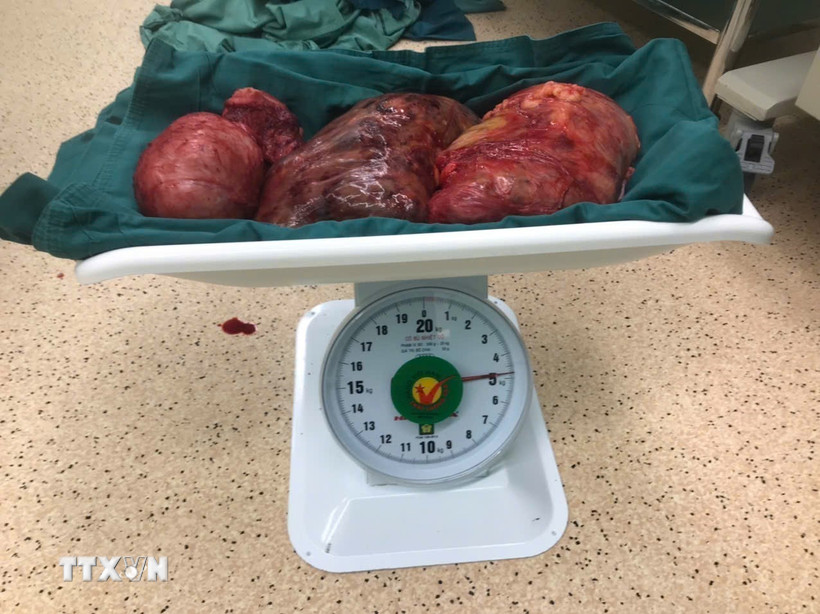 Khối u xơ tử cung được phẫu thuật lấy ra từ một bệnh nhân nữ tại thành phố Vũng Tàu. (Ảnh: Hoàng Nhị/TTXVN)