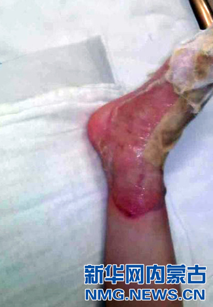 Bộ phận sinh dục của bé trai bị biến dạng sau khi bị bỏng ở trường ảnh 1