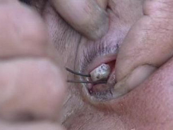 Kinh hoàng với những viên đá chui ra từ mí mắt người phụ nữ ảnh 1