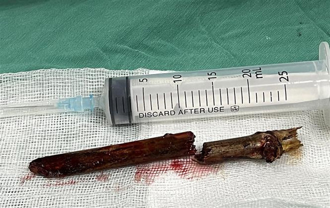 Phú Thọ: Cấp cứu nam thanh niên bị đoạn tre dài 15cm đâm vào cổ ​ ảnh 1