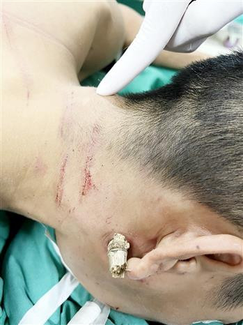 Phú Thọ: Cấp cứu nam thanh niên bị đoạn tre dài 15cm đâm vào cổ ​ ảnh 2