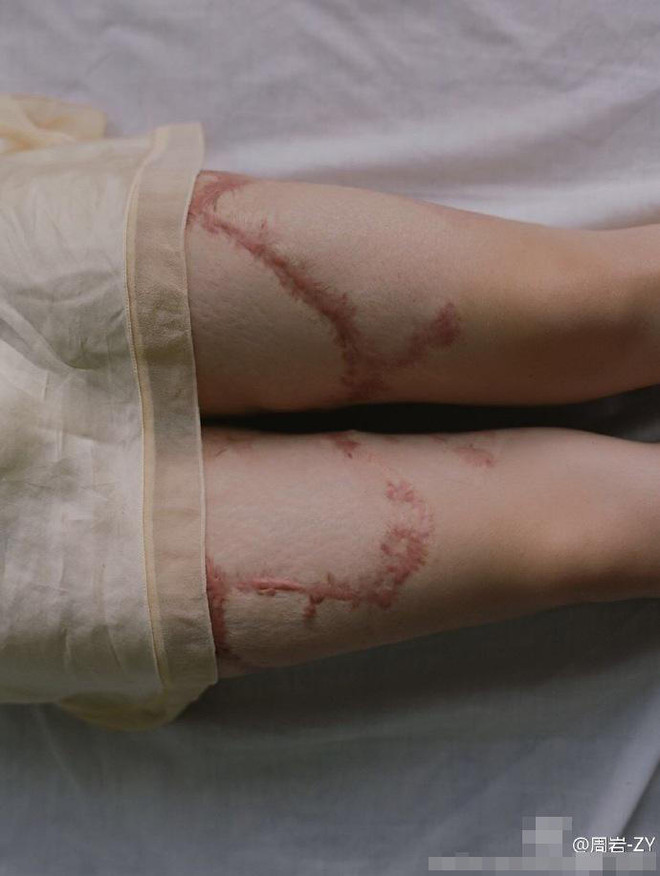 Bộ ảnh của cô gái bị bạn học tẩm xăng đốt gây sốt ở Trung Quốc ảnh 4